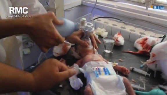 Syrian Baby Saved After being Hit by Shrapnel Inside Womb