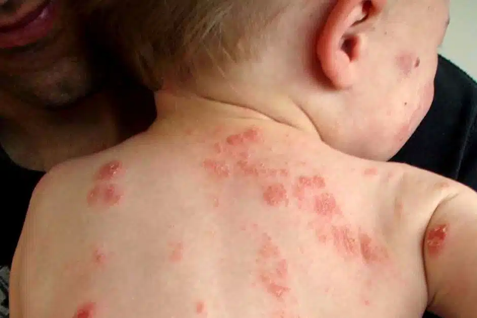 eczema child