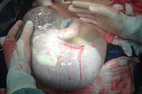 en-caul birth baby born in amniotic sac