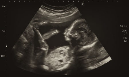 fetal ultrasound image