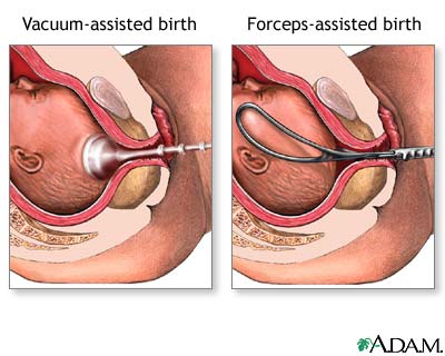 forcep vacuum delivery