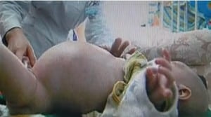 image of toddler Xiao Feng with distended stomach from parastic twin