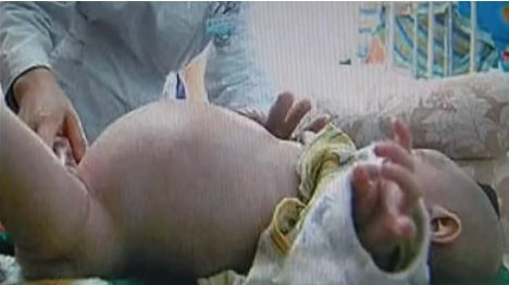 image of toddler Xiao Feng with distended stomach from parastic twin