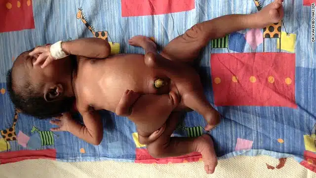 multiple limbed boy Paul Mukisa