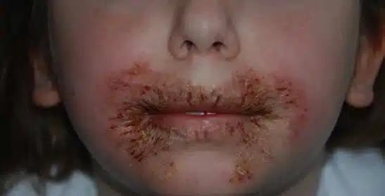 rash from baby wipes