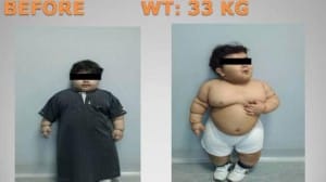 toddler bariatric surgery