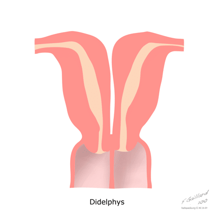 uterus didelphys